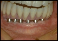 Bridge complet transvissé sur implants