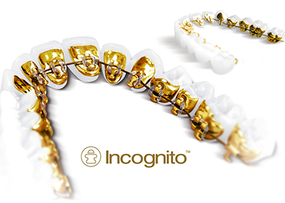 Orthodontie linguale